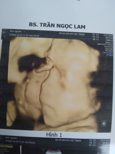 Em bé 25w 1kg có bự quá không các mon