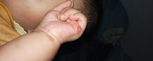 Bayi 5 bulan keluar bintik bernanah