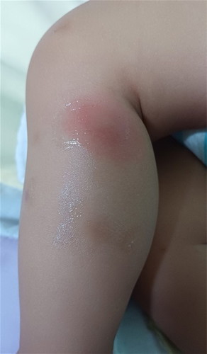 Insect bite po ba ito?