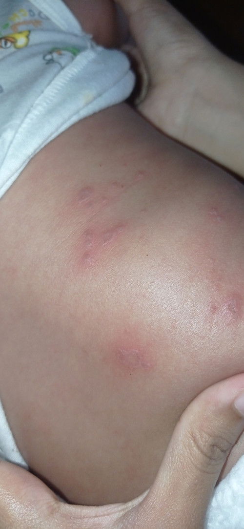 Kulit bayi unur 3 setengah bulan