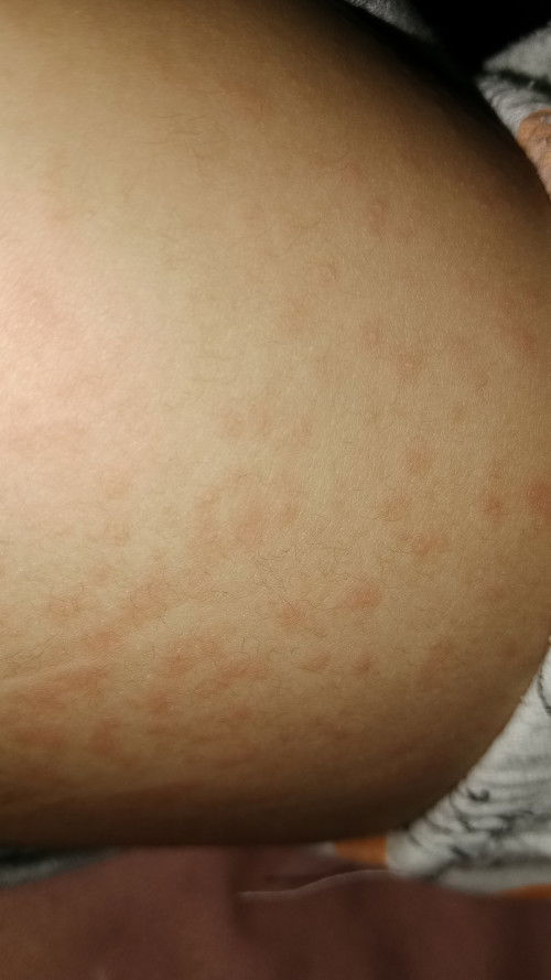 Roseola Pada Anak