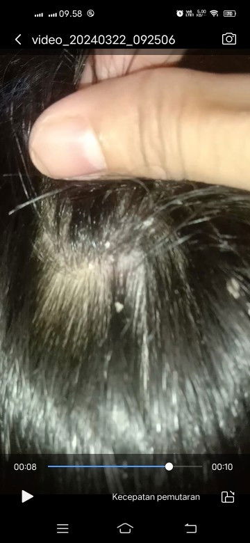 Kerak di kulit kepala