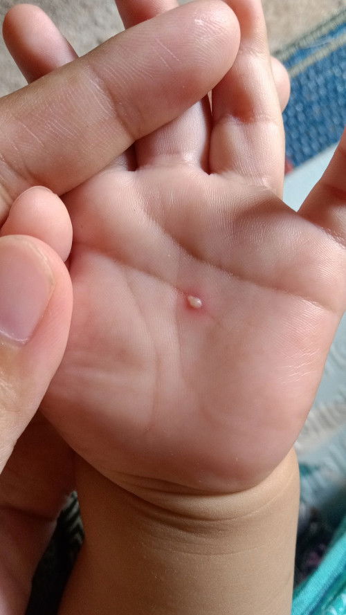 Plentingan di telapak tangan