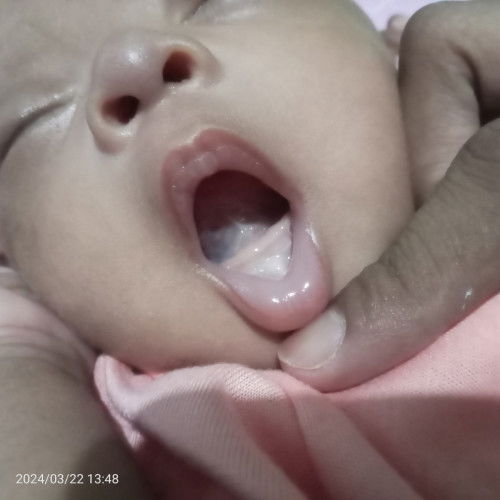 Lidah bayi sering naik ke atas langit2 rahang