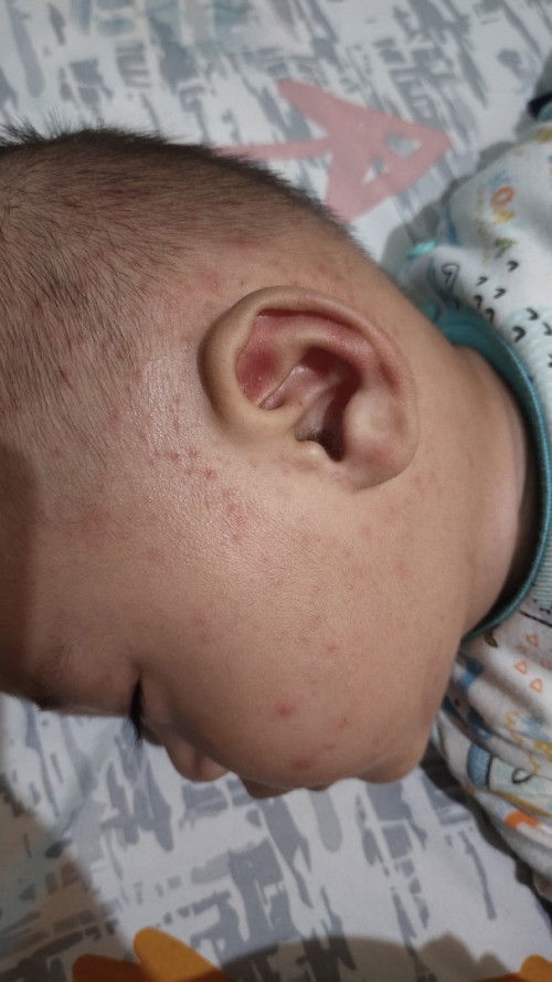 Bruntusan dimuka sebelah kiri aja.