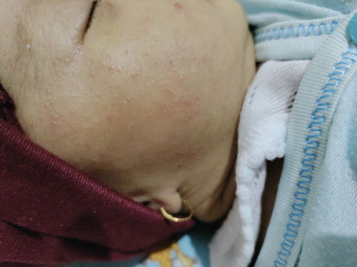 Muka bayi beruntusan