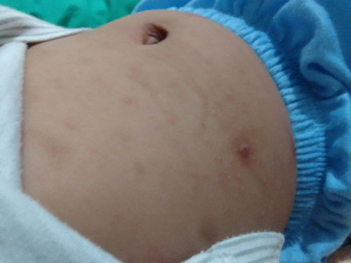 Bun mau tanya ada yg sama ga ya ini kaya jerawat gtu ada dmna" trus bisa pecah dan ngeluarin air....