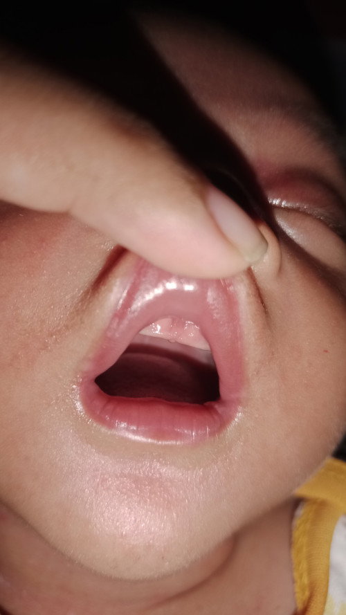 Lip tie pada bayi