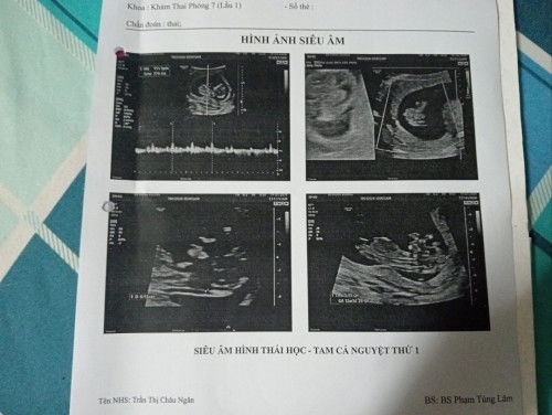 Có mom nào ngày dự sinh 1/10 ko ạ bé em hm nay đc 12w4 đo độ mờ vai gáy 1.3mm 
Tim thai 156