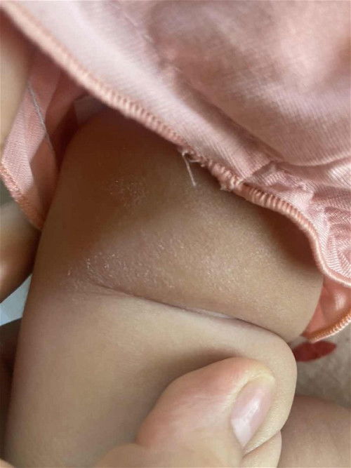 Lại là viêm da cơ địa 😭