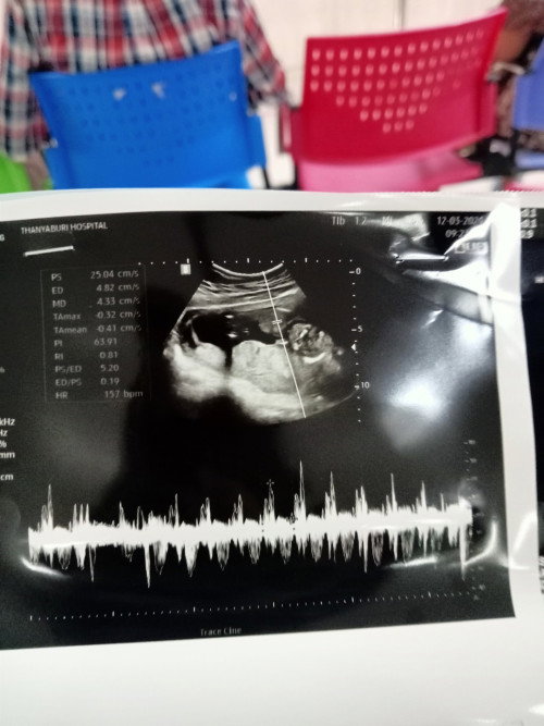 16สัปดา  # ลูกคนแรก