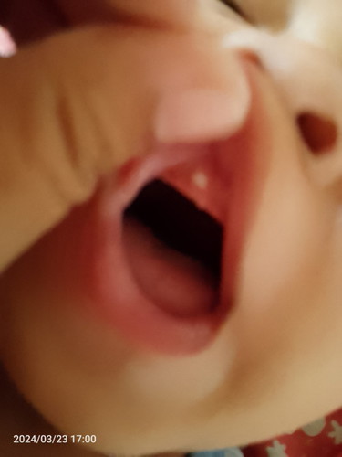 Ngipin ba ito