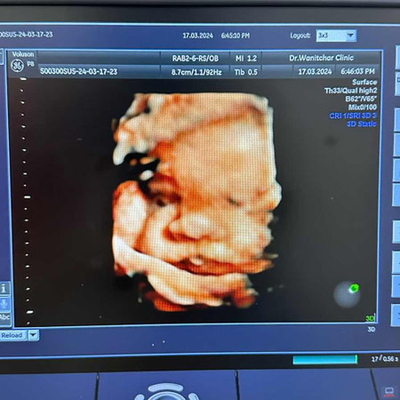 สอบถามน้ำหนักลูกและประสบการณ์การผ่าคลอด