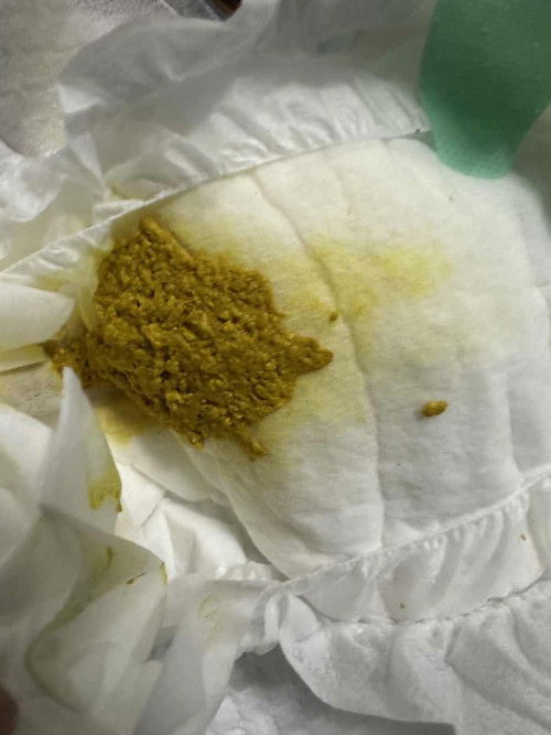 สอบถามแม่ๆหน่อยคะ อยากทราบอึลูกแบบนี้ปกติมั้ยคะ น้องทานนมแม่+นมผงค่ะ