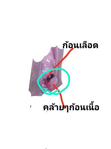 ก้อนเลือดมาคั่งตรงปากช่องคลอดค่ะ