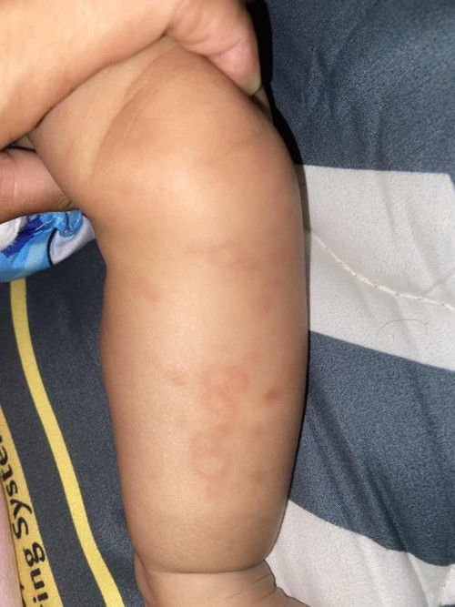 ผื่นอะไรช่วยตอบหน่อยคะ