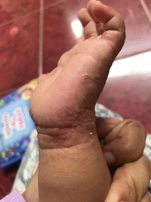 Apakah ini scabies?