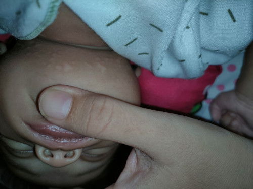 Bentol putih sekitar leher & tengkuk