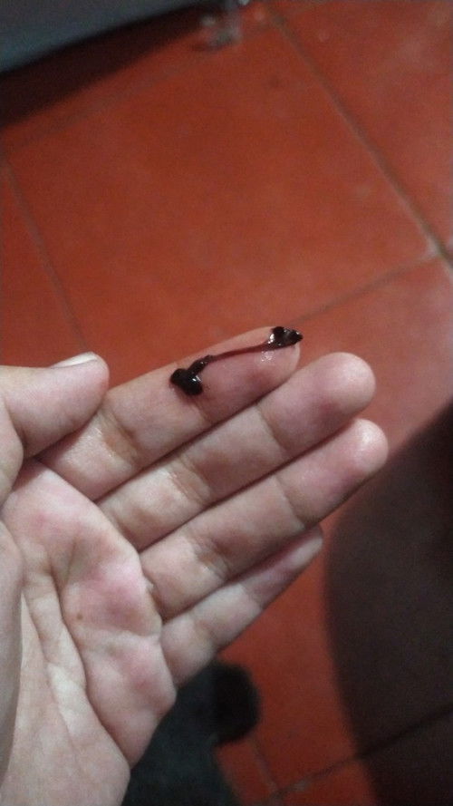 Keluar gumpalan  darah