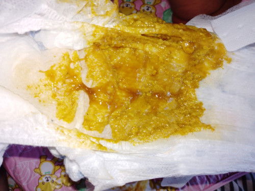 Parang plema sa poop newborn