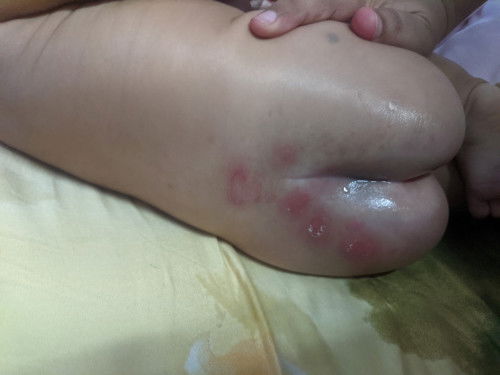 Merah pada punggung bby