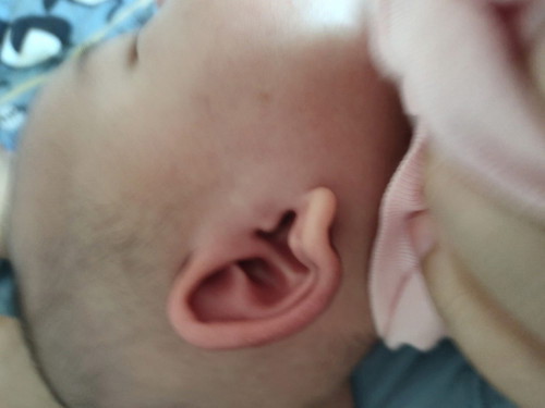 ลูก4เดือนหูบวมแดง