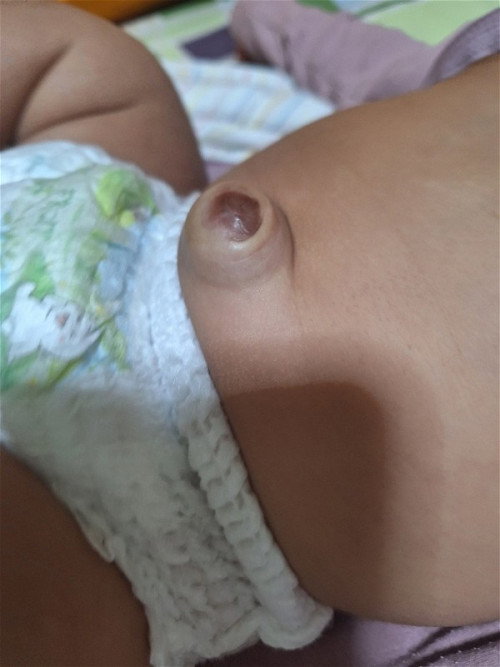 แม่ๆบ้านไหนสะดือลูกจุ่นแบบนี้บ้างคะ แบบนี้ปกติไหมคะต้องแก้ไขยังไงไหมคะ น้องสองเดือนละคะ