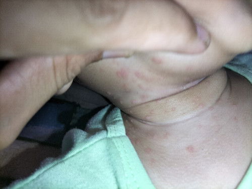 Bintik merah melebar di leher