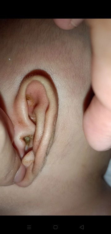 cairan ditelinga bayi