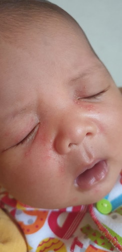Wajah bayi usia 20hari ruam dan bentol² kecil putih