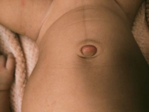 Bun ada yg anaknya gini juga ngak ya, bayi hampir 2 bulan tp puser e nya masih basah, pagi ini pas