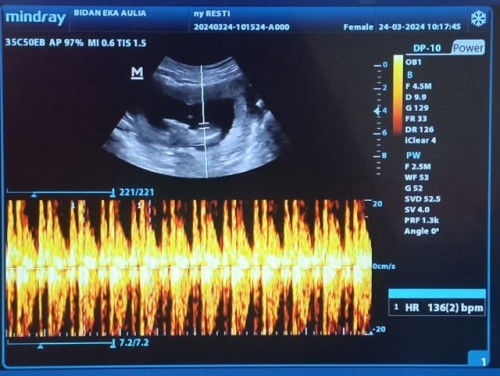 Hasil USG  usia kandungan 13w2d