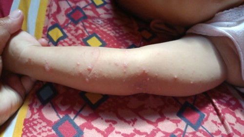 Ada gak ya yang lagi sama kayak anakku , tiba tiba gatal gatal di seluruh tubuh sampe begini ?