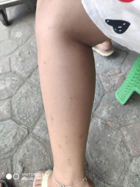 Cara menghilangkan bekas luka gatal