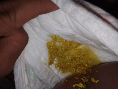 ถามแม่ๆหน่อยค่ะน้องถ่ายเป็นเมือก