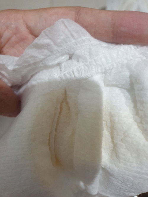 urin bayi berwarna gelap