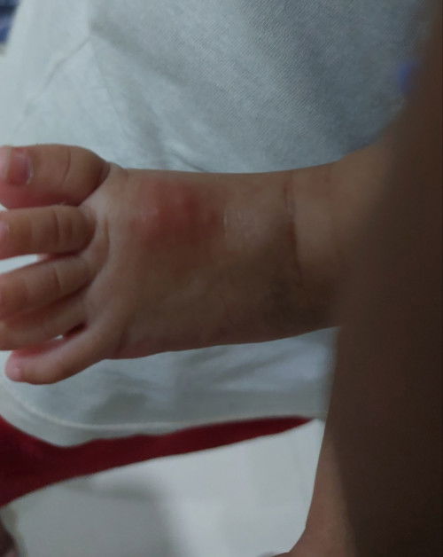 Bentol merah di kaki dan tangan