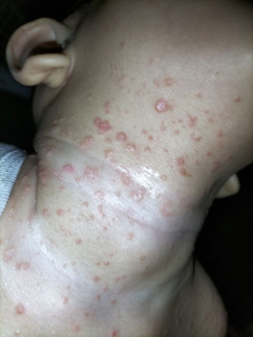 Bintik-bintik merah di leher