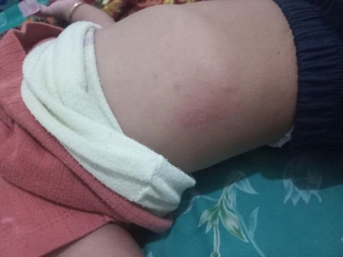 Bunda2 ada yg tau ga ini anak saya tbtb merah2 gtu, mukanya kayak bentol2 jg, rewel garuk trus..