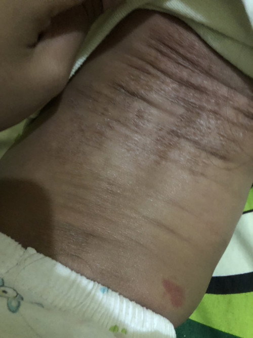 Kulit kering mengelupas
