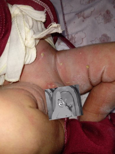 Bentol bentol bernanah