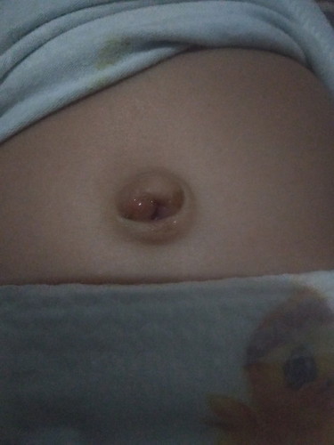 Ganyan po ang pusod ng bb ko . May konting amoy at mabasa po. Ano po bha ang tamang paglinis ?