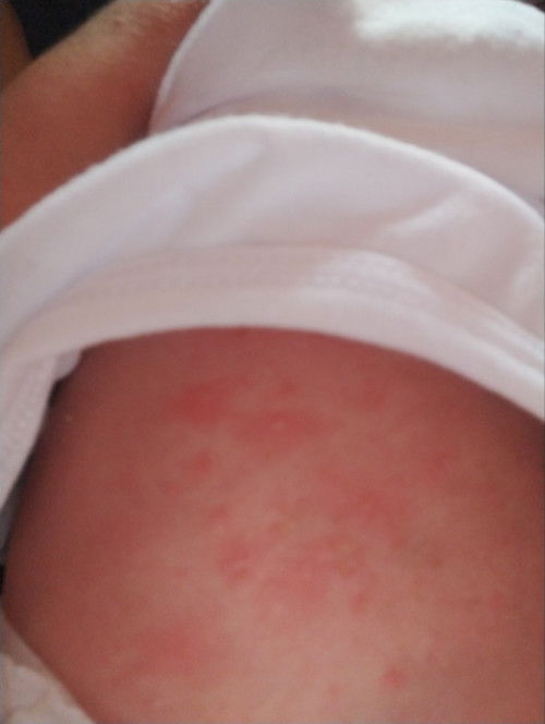 Hello po, sino po dito naka experience na nagkaroon ng sugat si baby si likod? parang paltos paltos