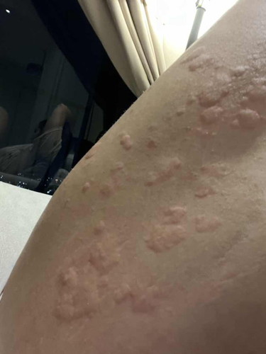 Skin Allergies and Hives
