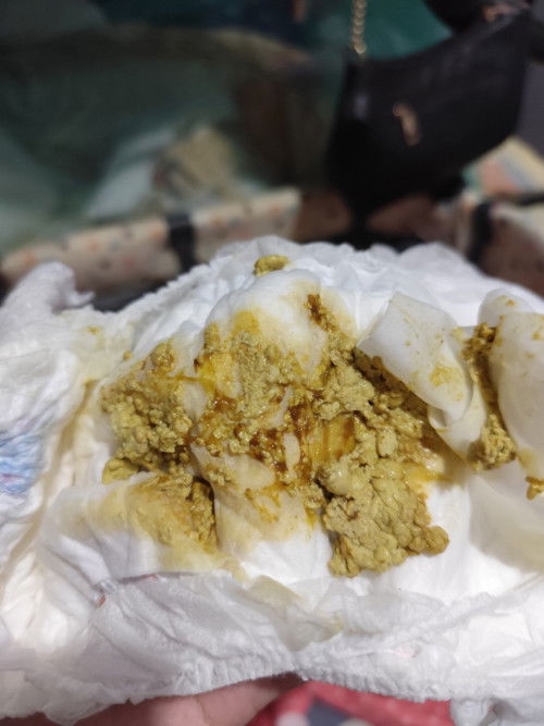 Baby poop super stress