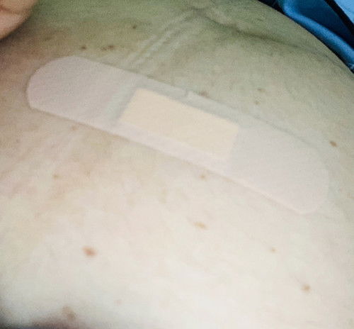 ประสบการณ์เจาะน้ำคร่ำ 17w +4d