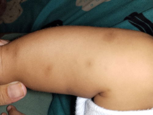 bekas gigitan nyamuk