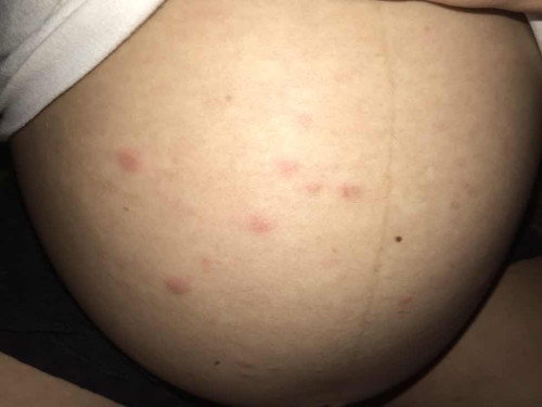 แม่ๆท้องบ้านไหนมีตุ่มแบบนี้บ้างคะ