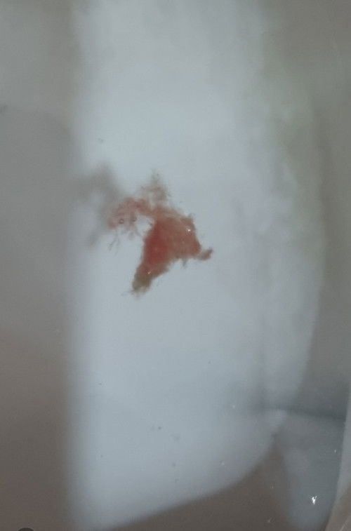 Hello po. Naka6x na po ako magpoop today and laging may Red Jellylike in Stool