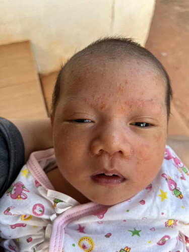 ลูกน้อยมีตุ่มขึ้นใบหน้า